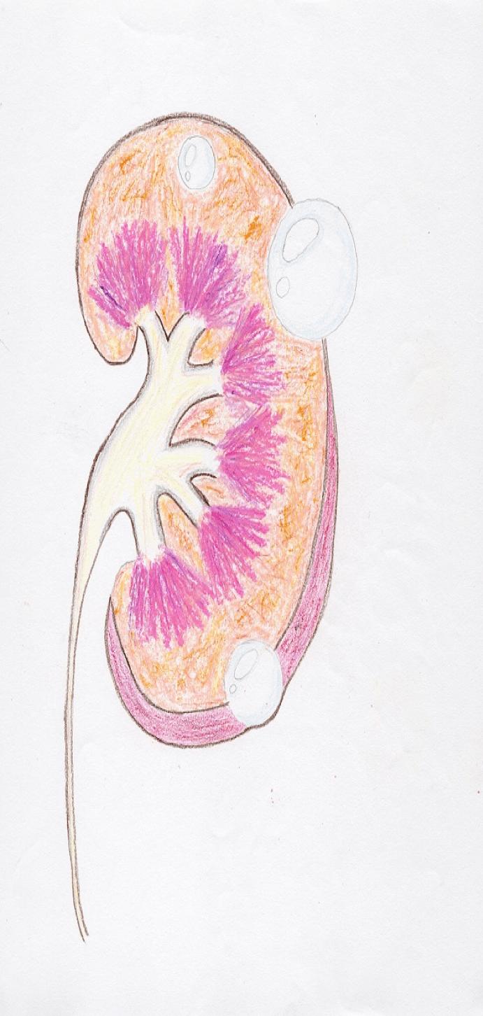腎臟囊泡